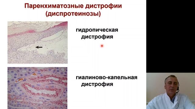 Патологическая анатомия 1.Введение.Дистрофии смотреть онлайн