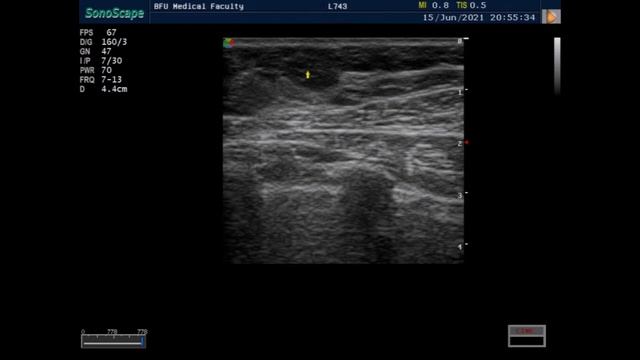 УЗИ молочных желез. Практическое занятие.