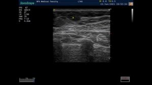 УЗИ молочных желез. Практическое занятие.