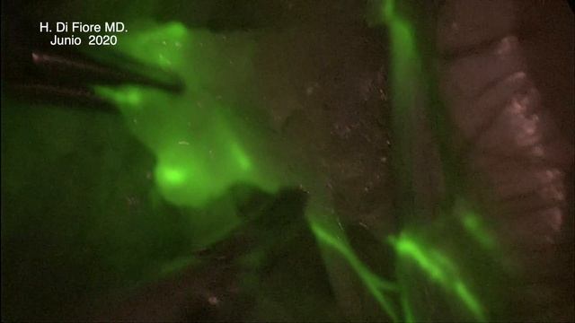 Use of Indocyanine Green for Sentinel Lymph Node Biopsy смотреть онлайн