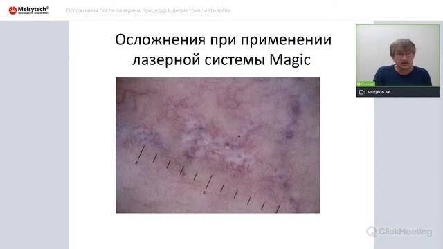 Осложнения после лазерных процедур в дерматокосметологии смотреть онлайн