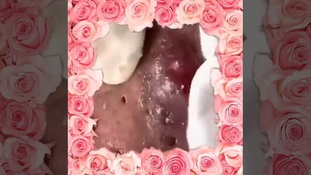 Pimple & Blackheads Popping - 25 смотреть онлайн