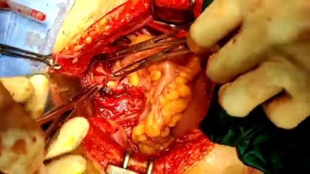 Endometrial Carcinoma Pelvic Lymph node Dissection смотреть онлайн
