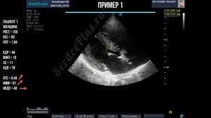 Гипертрофия левого желудочка на эхокардиографии