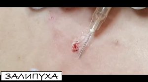 ПРЫЩИ. ДАВИМ ПРЫЩИ НА СПИНЕ. ВЫДАВЛИВАНИЕ ПРЫЩЕЙ НА СПИНЕ #прыщи #acne #asmr #прыщинаспине