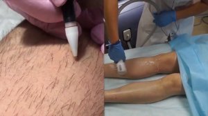 Электроэпиляция - удаление волос навсегда, любого цвета и типа