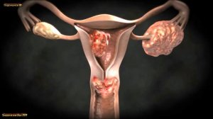 Как Определить Рак Матки по Первым Симптомам?