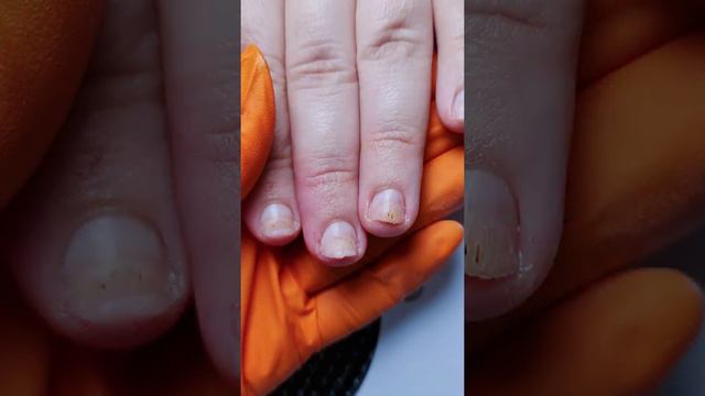 термический + химический ожог. Результат 2х месячной работы смотреть онлайн