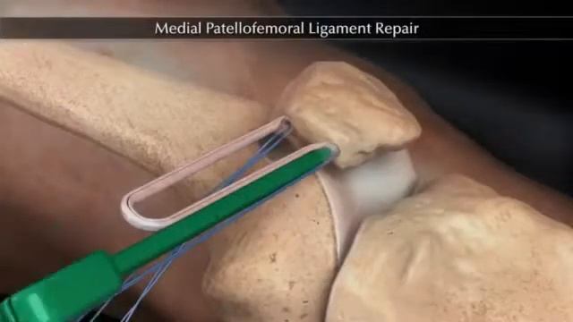 Укрепление надколенника при разрыв связки. смотреть онлайн