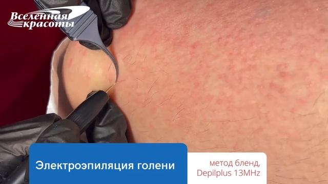 Электроэпиляция бёдер методом blend смотреть онлайн