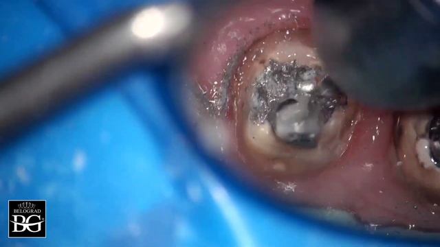 Crown and cast post removal. Удаление коронок и вкладок. смотреть онлайн