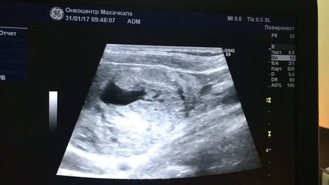 Узловой зоб. Пункция узла под контролем ультразвука.mp4 смотреть онлайн