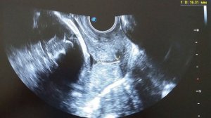 Короткая шейка матки по УЗИ. Как делают цервикометрию при беременности.