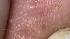 Blackhead Removal/Popping Pimples /Loan Nguyen/Nasa Spa/يمكن للناس أن يجعلوك سعيدا # 168