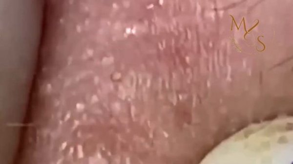 Blackhead Removal/Popping Pimples /Loan Nguyen/Nasa Spa/يمكن للناس أن يجعلوك سعيدا # 168