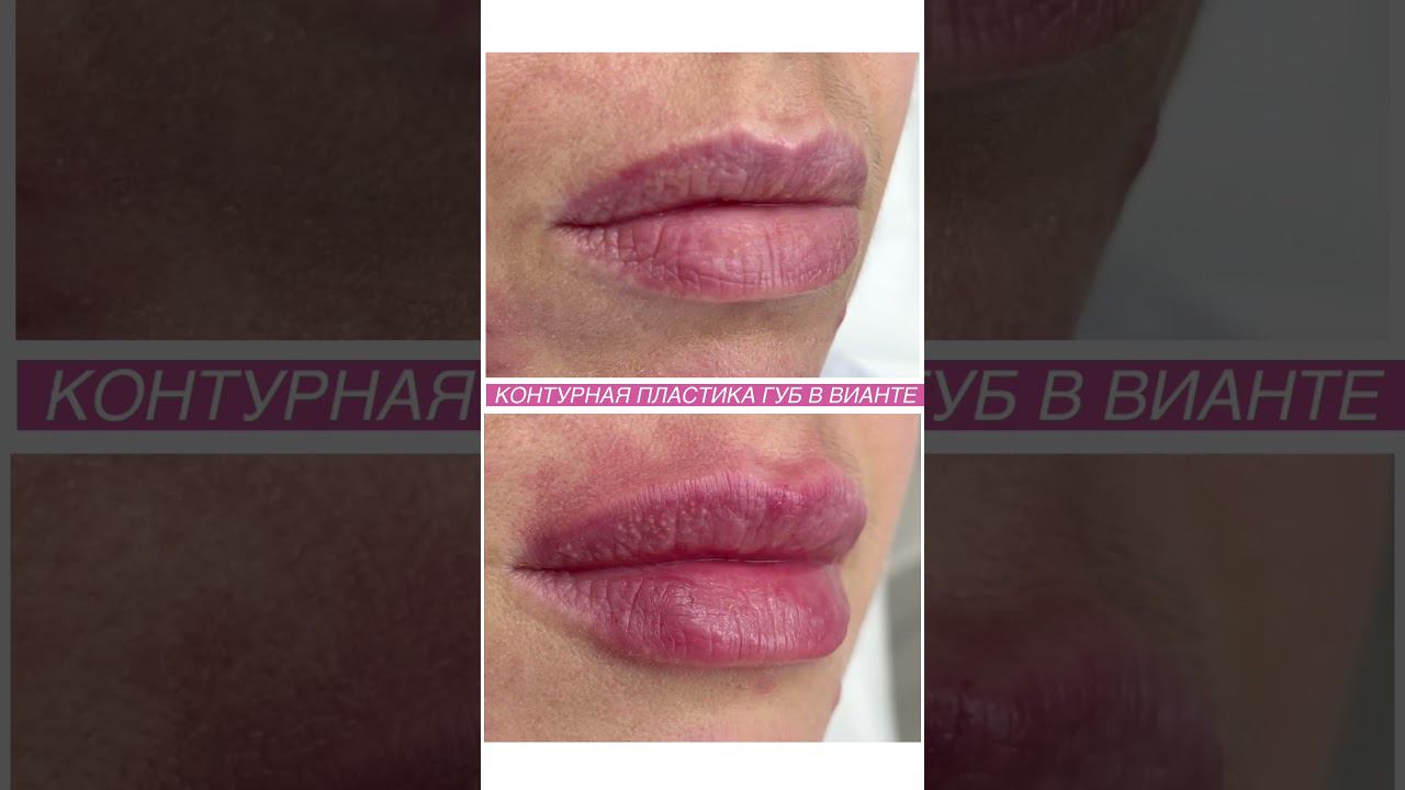 #губы #допосле контурной пластики смотреть онлайн
