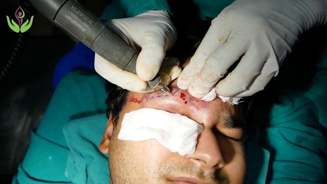 Eyebrow Transplant Leukotrichia in Segmental Vitiligo Treatment | Care Well Medical Centre смотреть онлайн