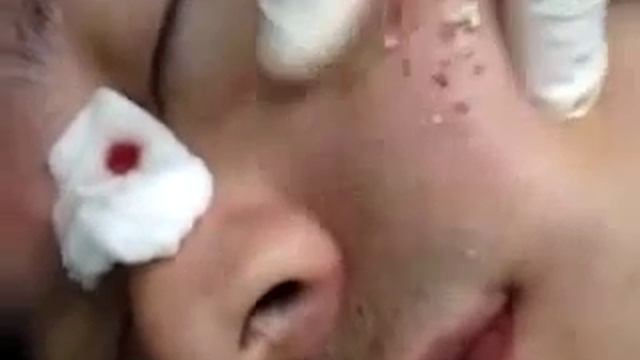 Как удалить угри! смотреть онлайн