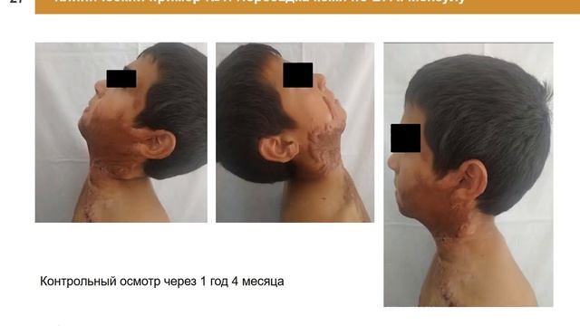 Пересадка кожи по Мензулу В. А. - Scin Grafting By Dr. Menzul