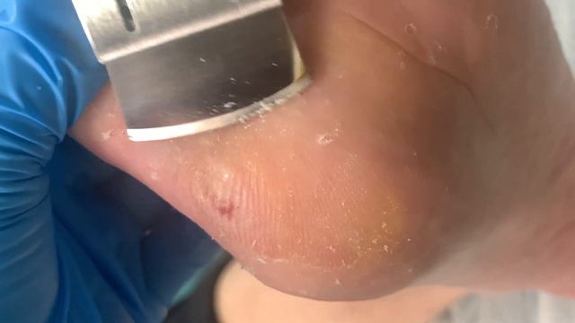 Feet callus removal& old skin cleaning【TD foot care】#stress 7 смотреть онлайн