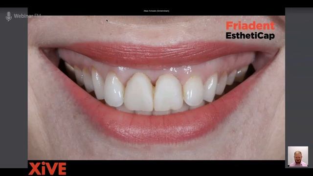Часть 2: XiVE - лучший выбор для одномоментной имплантации. Esthetic Cap. Вебинар И. Алгазина. смотреть онлайн