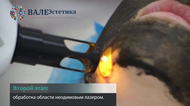 Карбоновый пилинг HD смотреть онлайн