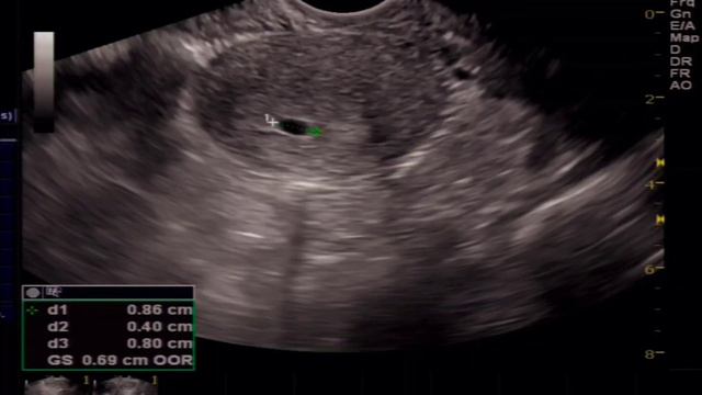 Ultrasound Early Pregnancy with Small Empty Gestational Sac , explained , what to do ?? смотреть онлайн