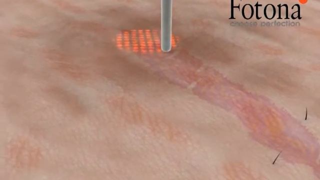 Stretch Marks removal FOTONA смотреть онлайн