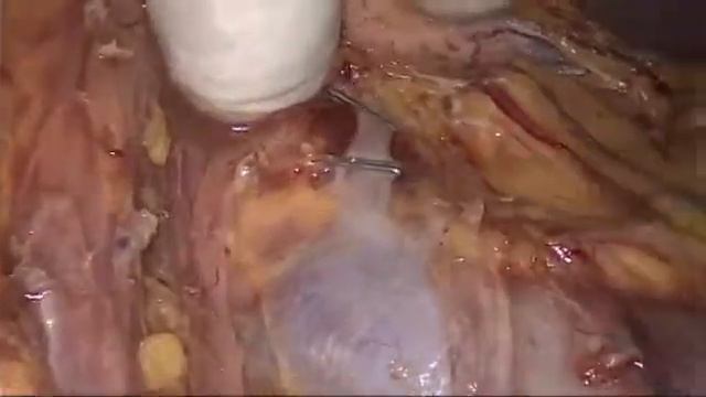 Лапароскопический мануально ассистированный забор донорской почки 13 10 2016