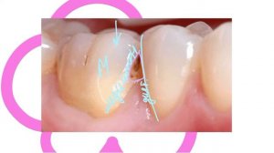 Классификация кариозных полостей Г.В. Блэк| G.V. Black