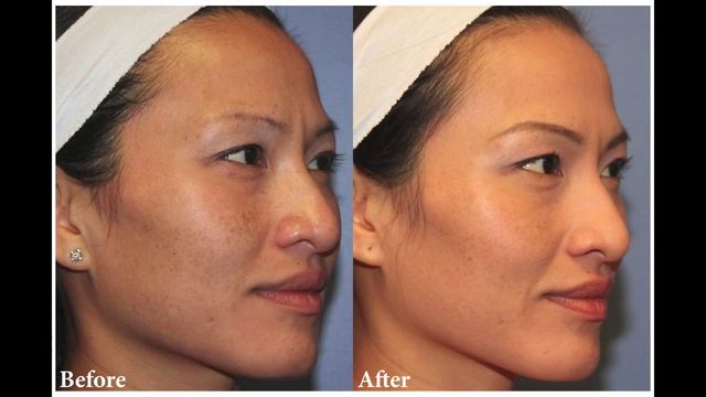 Clear + Brilliant @ Allegro MedSpa смотреть онлайн