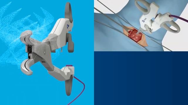 Точный диссектор LugaSure с нанопокрытием Covidien LF2019 смотреть онлайн