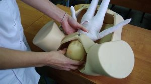 Биомеханизм родов при лобном предлежании