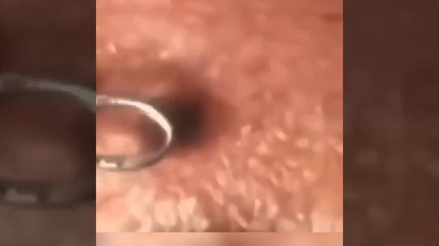 Давим угри. Чёрные точки.