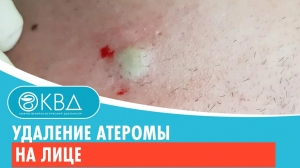 ✔ Удаление атеромы на лице. Клинический случай №484