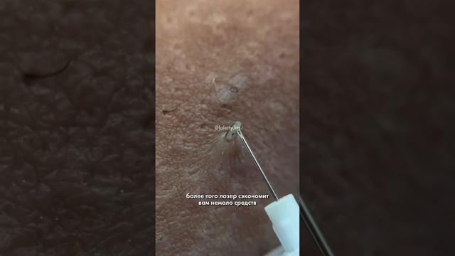 Всё ещё не знаете, как избавиться от вросших волос? ?#ЛазернаяЭпиляцияБишкек#ЛазернаяЭпиляция смотреть онлайн