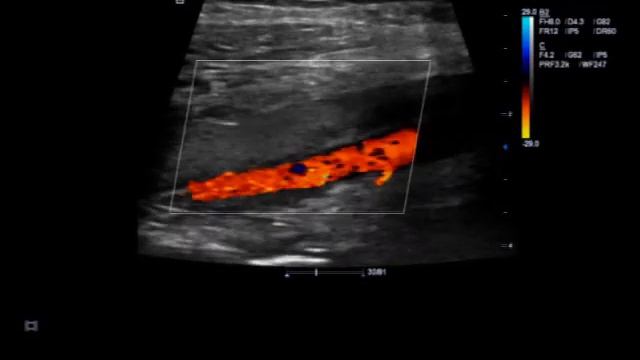 Подколенная ямка