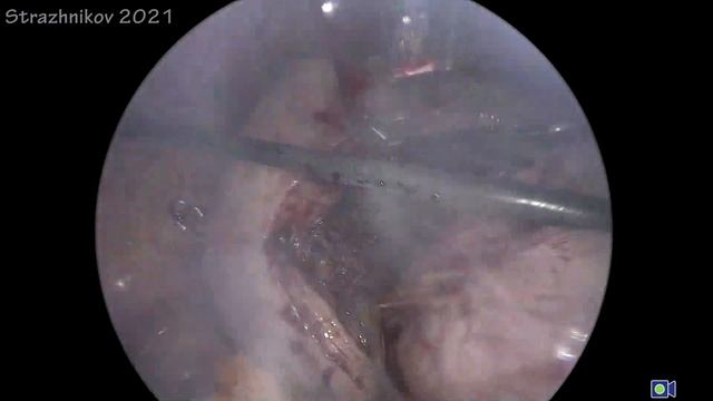 гигантская миома. смотреть онлайн