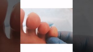 Аппаратный педикюр, натоптыши, мозоли