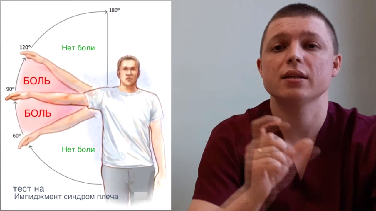 БОЛЬ В ПЛЕЧЕ Синдром сдавления вращательной манжеты плеча Shoulder Impingement