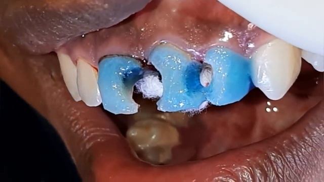 Эстетическая реставрация фронтальной группы зубов