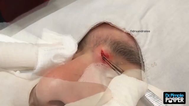 A Life-Changing Pop with Dr Pimple Popper смотреть онлайн