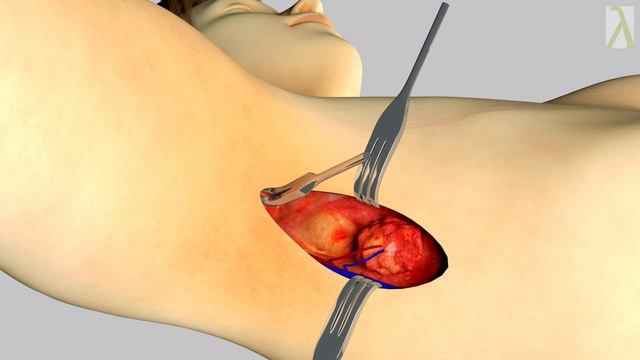 λ: Lymphedema Cure with a Local vascularized Lymph Node Transfer & BioBridge® CS смотреть онлайн
