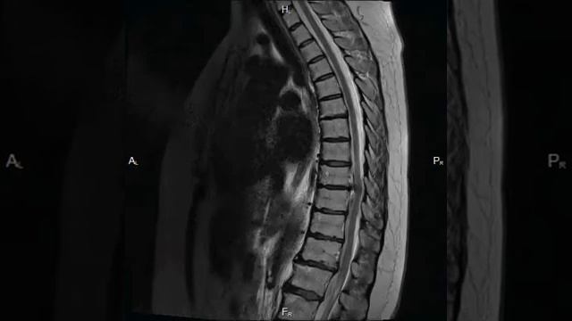 МРТ грудного отдела позвоночника на МРТ 1.5 Тесла Siemens Magnetom Avanto смотреть онлайн