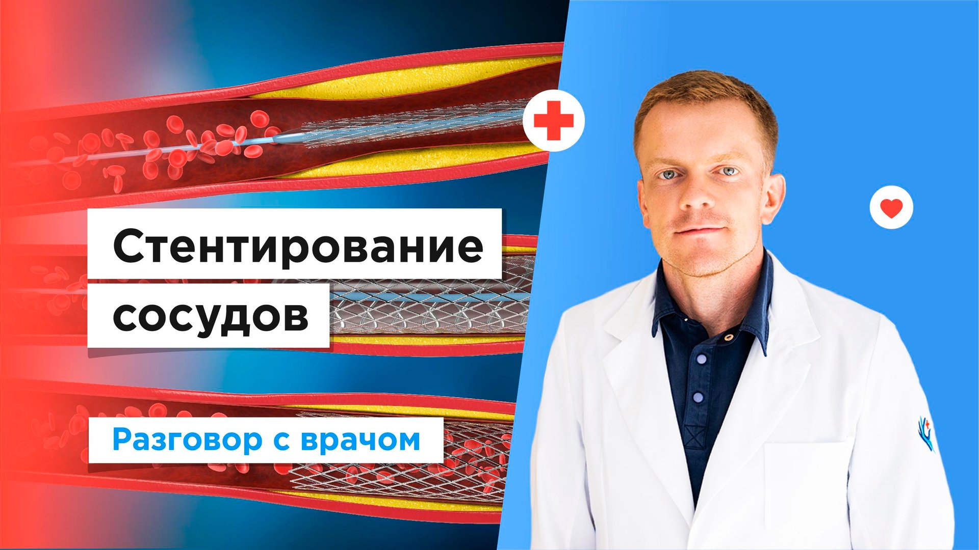 Стентирование сосудов в Москве бесплатно по полису ОМС смотреть онлайн