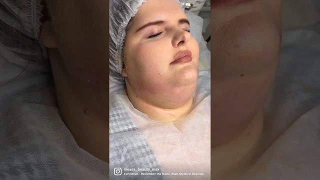 Липоредукция подбородка Пожизненный результат ! смотреть онлайн