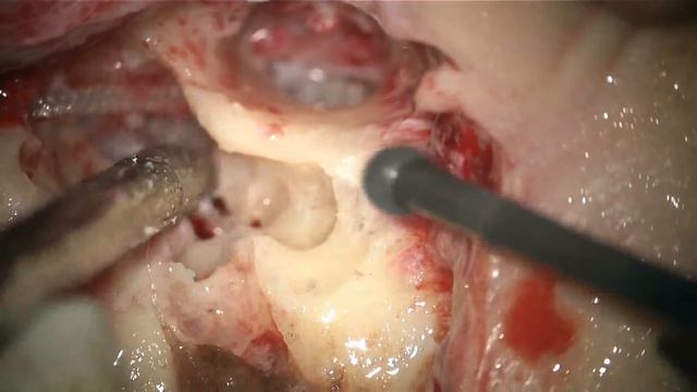 Cirugia Otorrinolaringologia - Insercion Reoperacion Implante Coclear de manera Facil - Medel - 153 смотреть онлайн