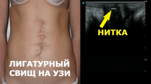 Как выглядит ЛИГАТУРНЫЙ СВИЩ на УЗИ?