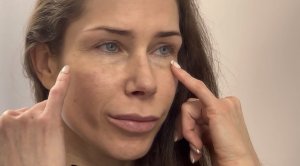 Круговая блефаропластика.