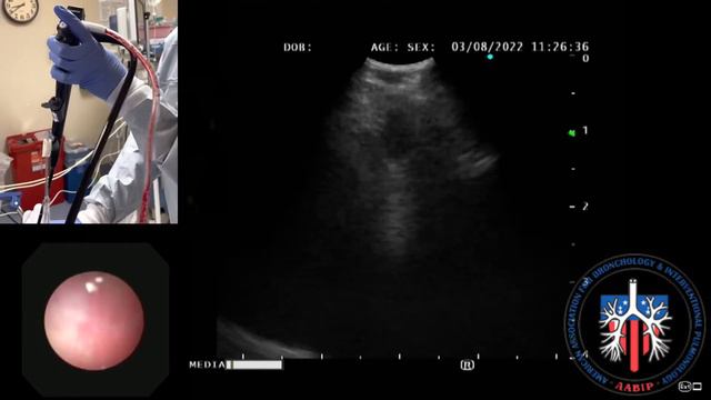 EBUS Lymph Node Station 2R смотреть онлайн